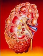 What Causes Polycystic Kidney Disease