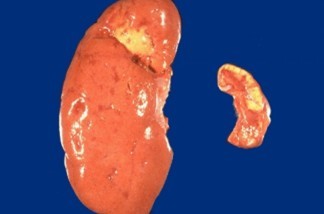 kidney atrophy causes