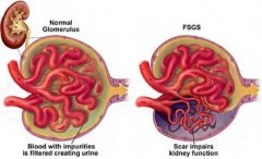 Reoccurrence Rate of FSGS after Kidney Transplant