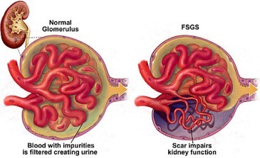 reoccurrence rate of FSGS after kidney transplant