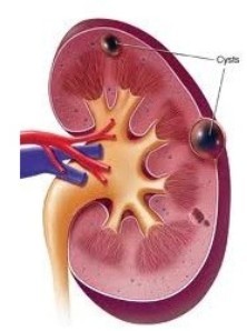 Simple Kidney Cyst