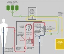 Blood Plasma Exchange in Treatment of Lupus Nephritis