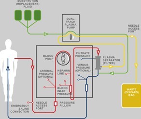 blood plasma exchange lupus