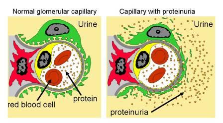 proteinuria