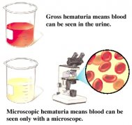 Blood in Urine Caused by PKD