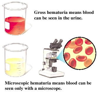 hematuria