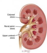 How are Stones Formed in the Kidneys
