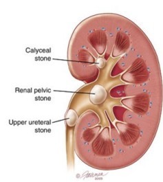 kidney stone causes