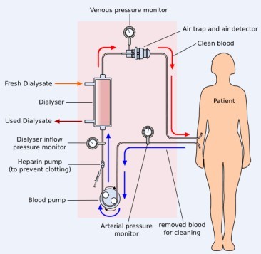 can i stop dialysis once I start