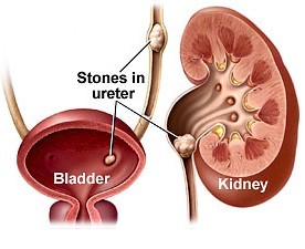 what is kidney stone prognosis