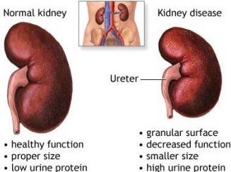 kidney disease causes