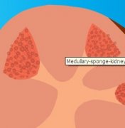 What is Medullary Sponge Kidney (MSK)