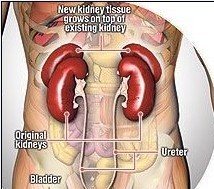 renal duplication symptoms