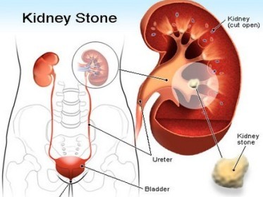 what causes kidney stone