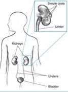What is a Cyst in the Kidneys