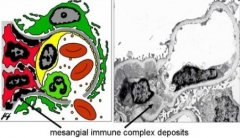 How is IgA Nephropathy Formed in Our Body