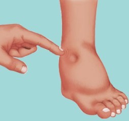 edema treatment in HSP 