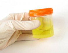 Whats the Uses of Doing Urine Test