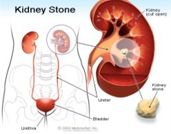 creatinine in kidney stone