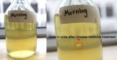 Urine Changes in Kidney Disease Patients by Herbal Medicine Treatment