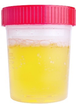 protein in urine