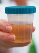 How To Treat Foamy Urine In Polycystic Kidney Disease
