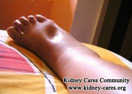 home remedy for swollen legs in kidney disease