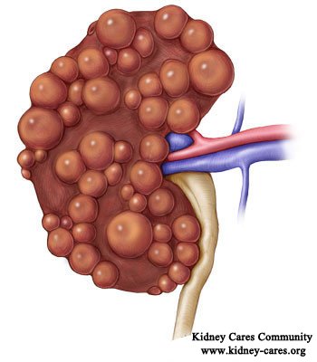 polycystic kidney disease 