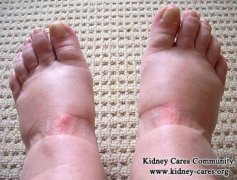 Treatment for Swollen Legs and Ankles in CKD Stage 5