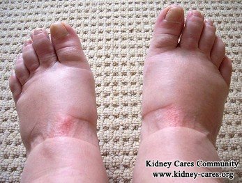 How do you treat swollen ankles caused by diabetes?