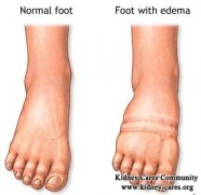 Swollen Hands and Feet in Nephrotic Syndrome