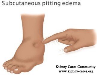 edema in nephrotic syndrome