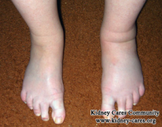Does Lupus Cause Ankle Swelling