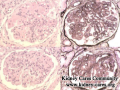 An Effective Treatment for Stage 4 Kidney Disease and Lupus