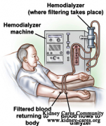 How To Prepare Dialysis