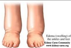 Does Edema Mean You Have Experienced CKD
