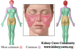 Blood Pollution Therapy: An Effective Treatment for Lupus