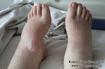 Breath Shortness And Swelling Disappear in a Renal Patient