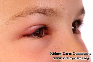 Causes of Puffy Eyes in Diabetes