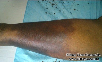 Diabetes:Leg Pain And Swelling Recover with Natural Herbs