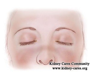 How to prevent chronic kidney disease (CKD) in lupus?