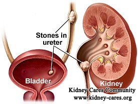 Why Does Kidney Stone Occur in PKD