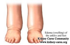 High Creatinine And Edema in Legs in Diabetes