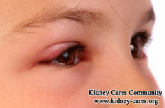 What Are Symptoms Of Stage 3 Lupus Nephritis