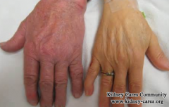 CKD Stage 5 And Changes In Skin Color:Causes And Management