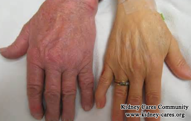 CKD Stage 5 And Changes In Skin Color:Causes And Management
