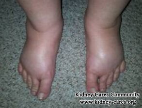 Causes And Management Of Feet Swell with Kidney Failure