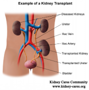 IgA Nephropathy, Kidney Transplant, Decreased Urine Output, Creatinine 6.8