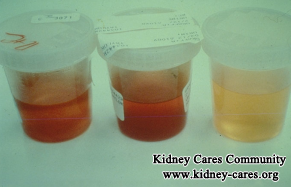 Why IgA Nephropathy Patients Have Blood in Urine