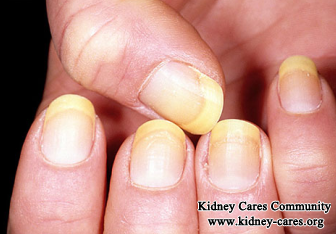 Fingernail Changes In Early Kidney Failure